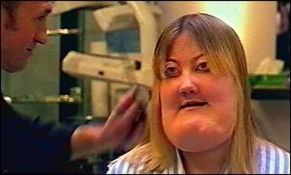 โรค Cherubism โรค Cherubism