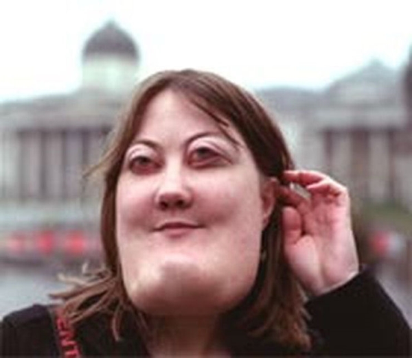 โรค Cherubism โรค Cherubism