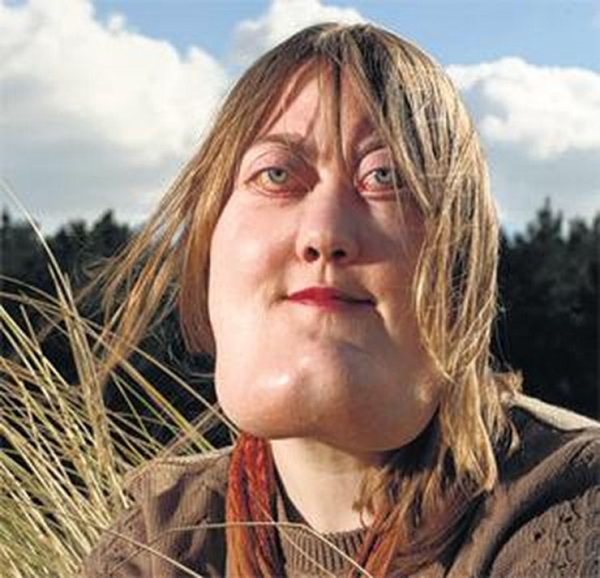 โรค Cherubism โรค Cherubism