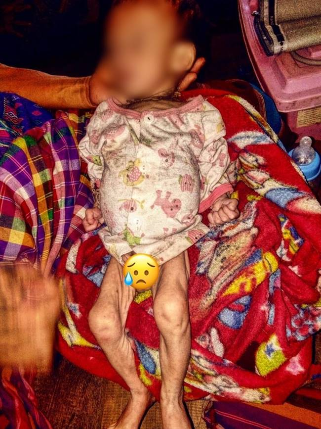 เด็กขาดสารอาหาร เด็กขาดสารอาหาร