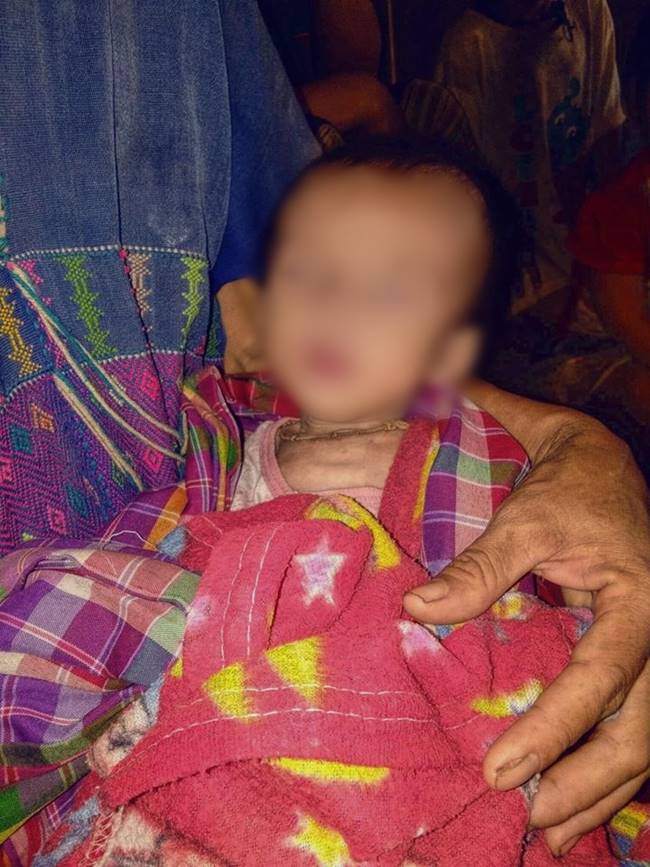 เด็กขาดสารอาหาร เด็กขาดสารอาหาร