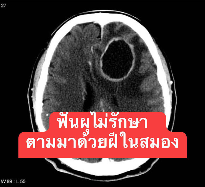 ฝันผุไม่รักษา ฝันผุไม่รักษา