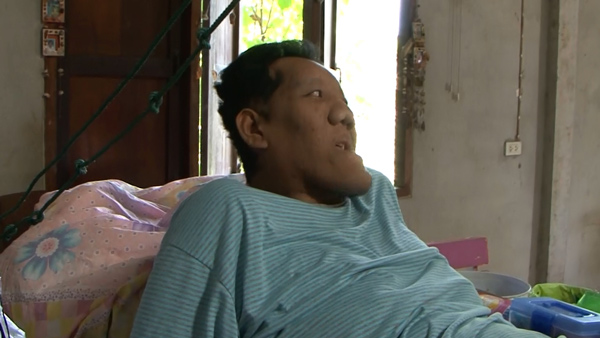 วอนช่วยหนุ่มสุรินทร์ ฮอร์โมนผิดปกติ สูงเกือบ 3 เมตร-โรครุมเร้า วอนช่วยหนุ่มสุรินทร์ ฮอร์โมนผิดปกติ สูงเกือบ 3 เมตร-โรครุมเร้า