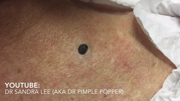 สิวหัวดำ สิวหัวดำ