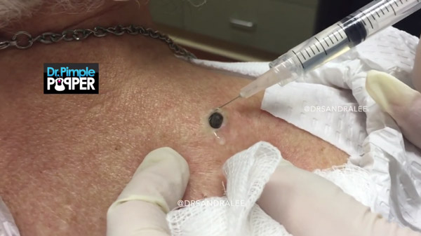 สิวหัวดำ สิวหัวดำ