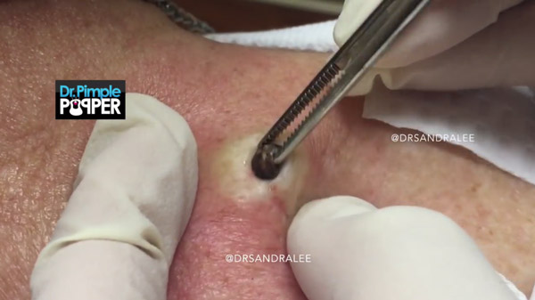 สิวหัวดำ สิวหัวดำ