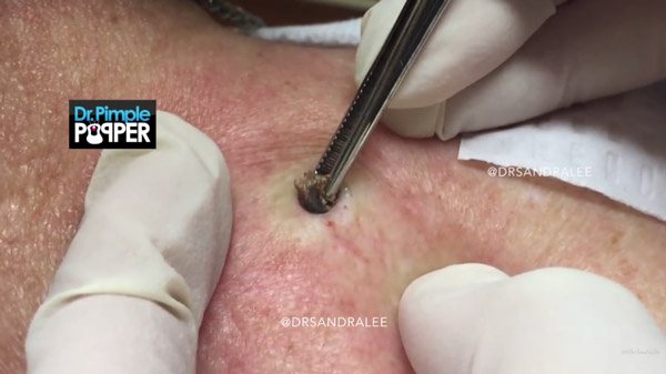 สิวหัวดำ สิวหัวดำ