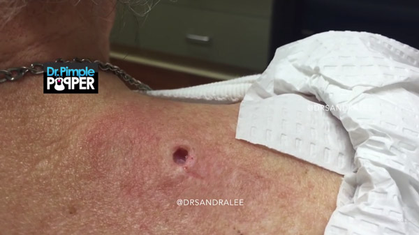 สิวหัวดำ สิวหัวดำ