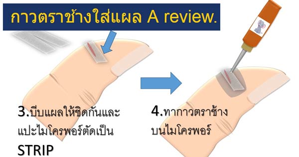 ใช้กาวตาช้างใส่แผล ใช้กาวตาช้างใส่แผล