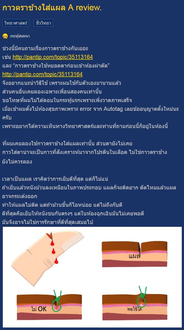 ใช้กาวตาช้างใส่แผล ใช้กาวตาช้างใส่แผล