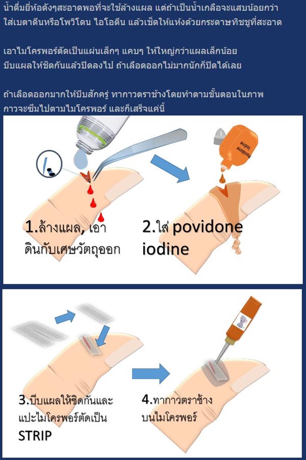 ใช้กาวตาช้างใส่แผล ใช้กาวตาช้างใส่แผล