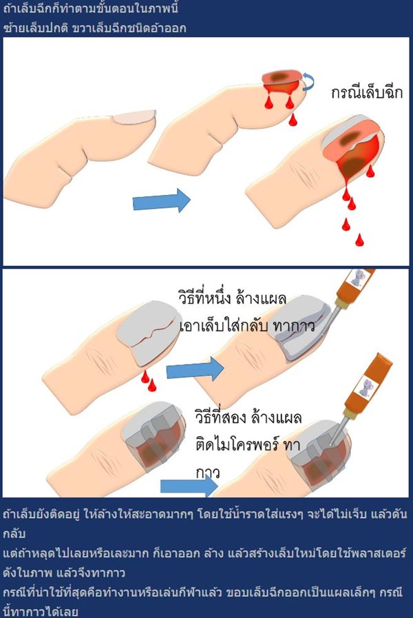 ใช้กาวตาช้างใส่แผล ใช้กาวตาช้างใส่แผล