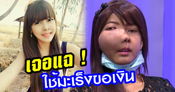 เพจดังแฉ สาวเป็นมะเร็งที่หน้า เพจดังแฉ สาวเป็นมะเร็งที่หน้า