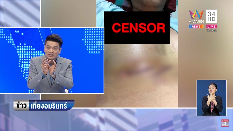 ศัลยกรรมนมเน่า ศัลยกรรมนมเน่า