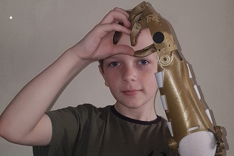 พ่อสร้างแขนกลให้ลูกพิการ พ่อสร้างแขนกลให้ลูกพิการ