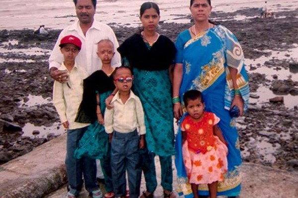 โรคแก่ก่อนวัย โรคแก่ก่อนวัย