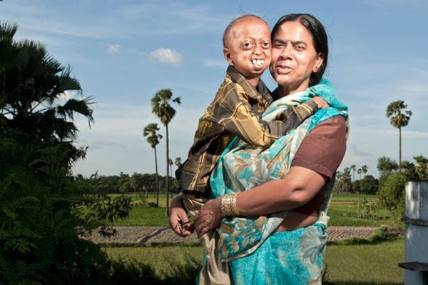 โรคแก่ก่อนวัย โรคแก่ก่อนวัย