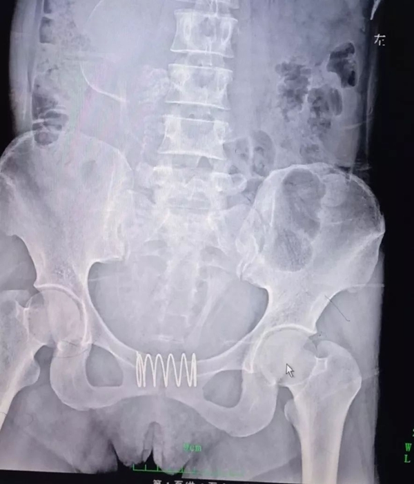 คุมกำเนิดผิดวิธี คุมกำเนิดผิดวิธี