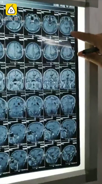 พยาธิไชสมอง พยาธิไชสมอง