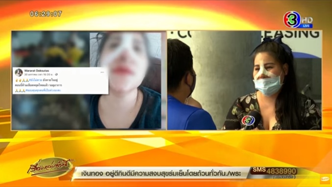 ศัลยกรรมจมูกพลาด ศัลยกรรมจมูกพลาด