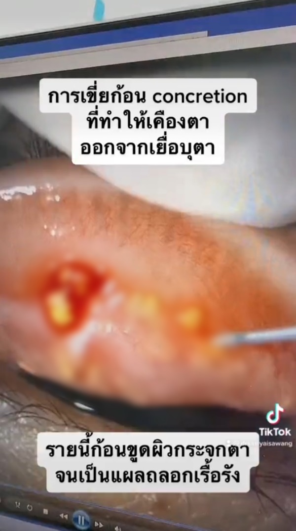 หินปูนในตา หินปูนในตา