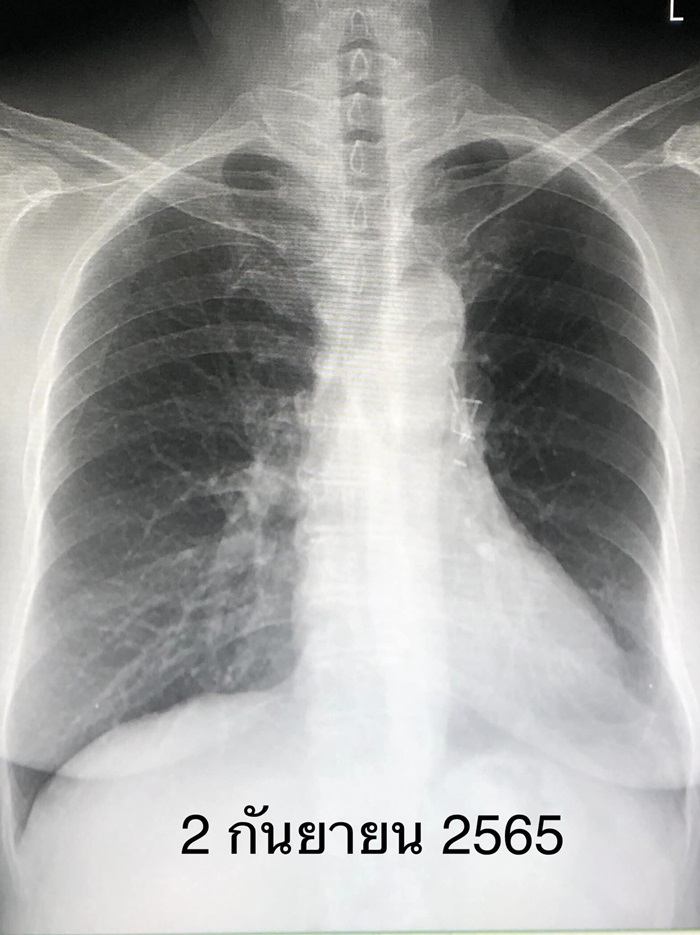 มะเร็งปอด มะเร็งปอด