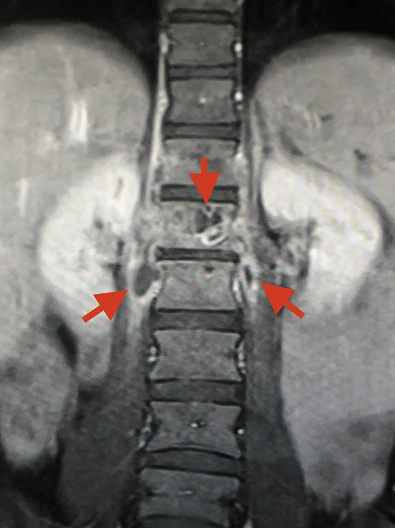 วัณโรคกระดูกสันหลัง วัณโรคกระดูกสันหลัง