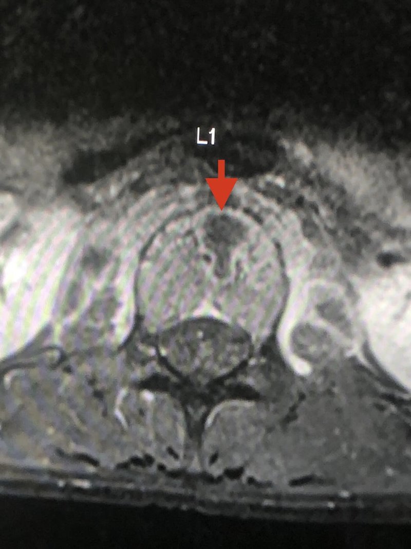 วัณโรคกระดูกสันหลัง วัณโรคกระดูกสันหลัง