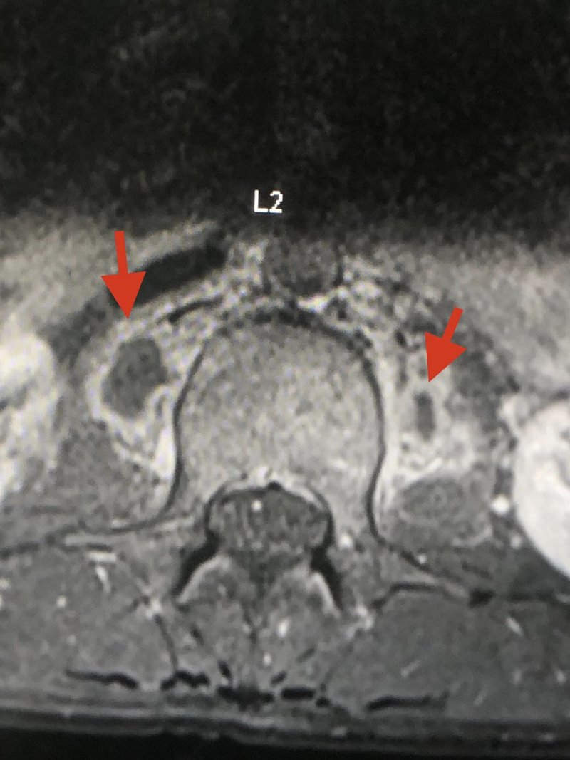 วัณโรคกระดูกสันหลัง วัณโรคกระดูกสันหลัง
