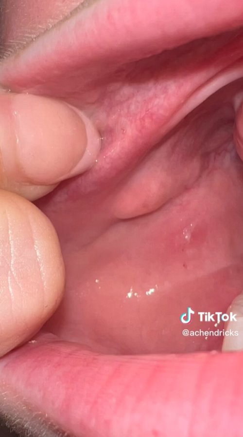 เมล็ดดอกไม้แทงกระพุ้งแก้ม เมล็ดดอกไม้แทงกระพุ้งแก้ม