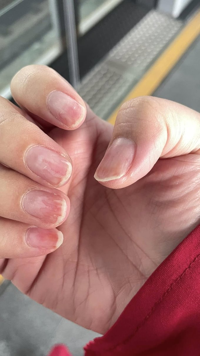 เตือนภัยคนชอบทำเล็บเจล เล็บติดเชื้อ แต่ร้านกลับเสนอทำฟรีอีก 1 เดือน เตือนภัยคนชอบทำเล็บเจล เล็บติดเชื้อ แต่ร้านกลับเสนอทำฟรีอีก 1 เดือน