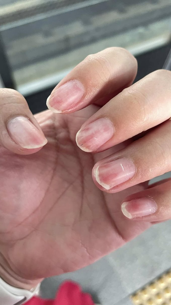 เตือนภัยคนชอบทำเล็บเจล เล็บติดเชื้อ แต่ร้านกลับเสนอทำฟรีอีก 1 เดือน เตือนภัยคนชอบทำเล็บเจล เล็บติดเชื้อ แต่ร้านกลับเสนอทำฟรีอีก 1 เดือน