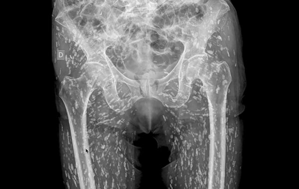 ภาพเอกซเรย์ ไข่พยาธิตัวตืดกลายเป็นหินปูน ในร่างกายคน ภาพเอกซเรย์ ไข่พยาธิตัวตืดกลายเป็นหินปูน ในร่างกายคน