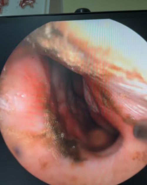 เปิดสภาพภายในจมูกคนไข้ หลังรับฝุ่น PM2.5 ปอดจะขนาดไหน เปิดสภาพภายในจมูกคนไข้ หลังรับฝุ่น PM2.5 ปอดจะขนาดไหน