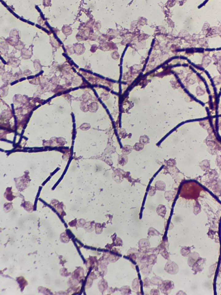 เปิดไทม์ไลน์ ผู้เสียชีวิตจากโรคแอนแทรกซ์ 1 ราย ในไทย เปิดไทม์ไลน์ ผู้เสียชีวิตจากโรคแอนแทรกซ์ 1 ราย ในไทย