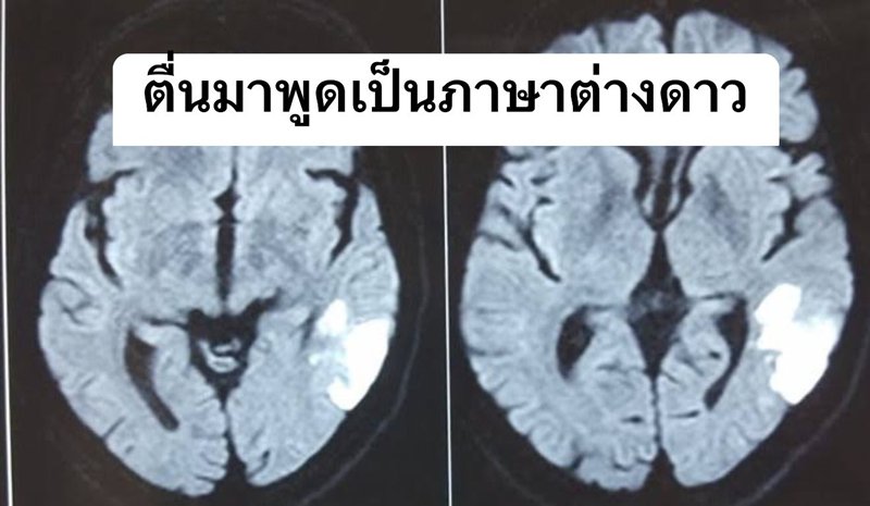 หมอเล่าเคส สามีคนไข้ตื่นมาพูดภาษาต่างดาว ฟังแล้วรู้ โรคอะไร หมอเล่าเคส สามีคนไข้ตื่นมาพูดภาษาต่างดาว ฟังแล้วรู้ โรคอะไร