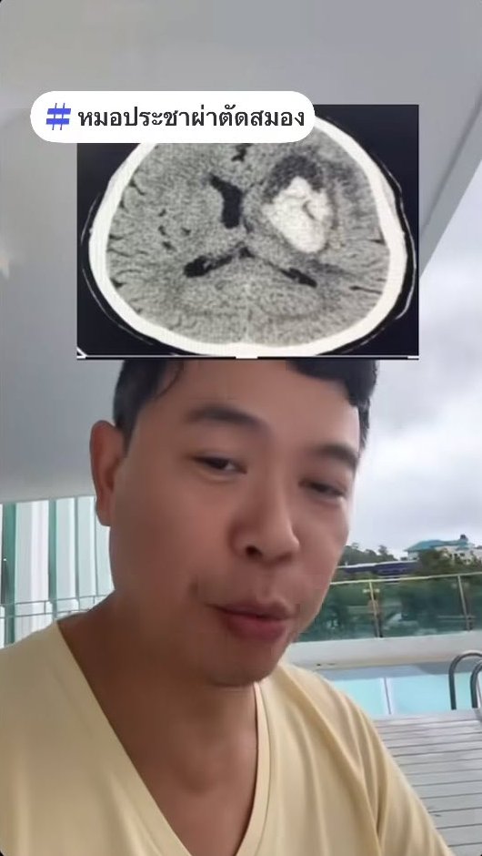 หมอประชาเตือน คนเป็นความดัน ดื่มกาแฟตอนเช้าตรู่ เสี่ยงเส้นเลือดสมองแตก หมอประชาเตือน คนเป็นความดัน ดื่มกาแฟตอนเช้าตรู่ เสี่ยงเส้นเลือดสมองแตก