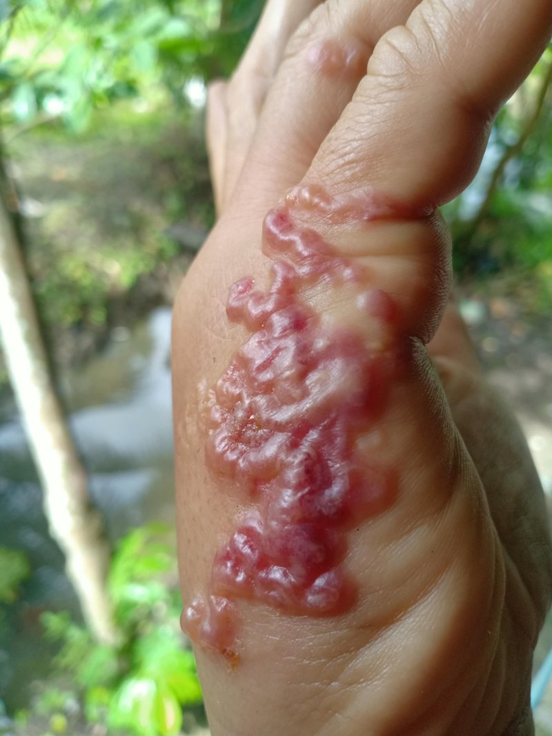 พยาธิไชผิวหนัง ตุ่มหนองขึ้นลามเป็นแถบ เกิดจากอะไร พร้อมแนะวิธีป้องกัน พยาธิไชผิวหนัง ตุ่มหนองขึ้นลามเป็นแถบ เกิดจากอะไร พร้อมแนะวิธีป้องกัน