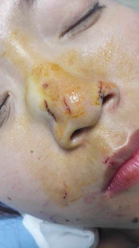 งูกัดหน้า งูกัดหน้า