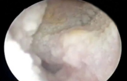 กาวหยอดหู กาวหยอดหู