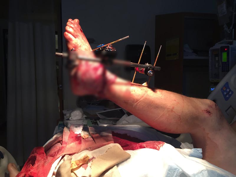 กินเนื้อมนุษย์ กินเนื้อมนุษย์