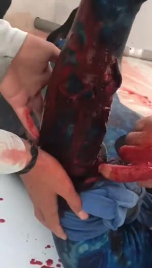 ถูกฉลามกัด ถูกฉลามกัด