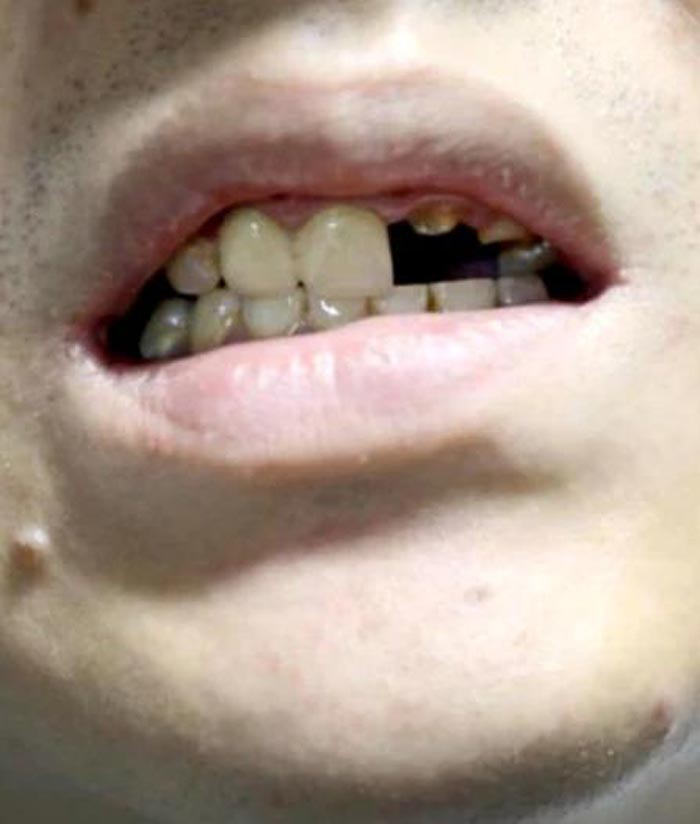 ฟันหัก ฟันหัก