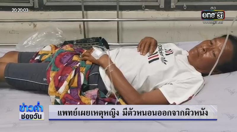 หนอนออกจากร่าง หนอนออกจากร่าง