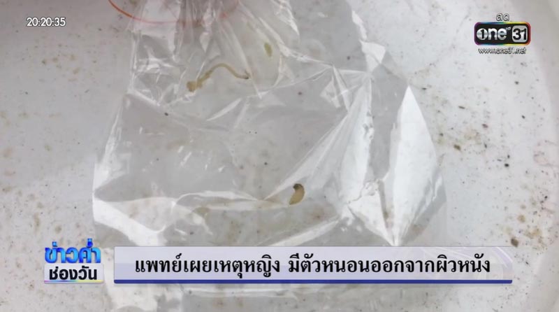 หนอนออกจากร่าง หนอนออกจากร่าง