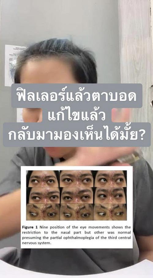 ฉีดฟิลเลอร์ตาบอด ฉีดฟิลเลอร์ตาบอด