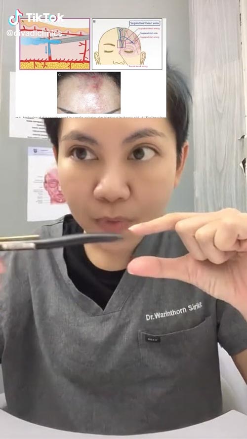 ฉีดฟิลเลอร์ตาบอด ฉีดฟิลเลอร์ตาบอด