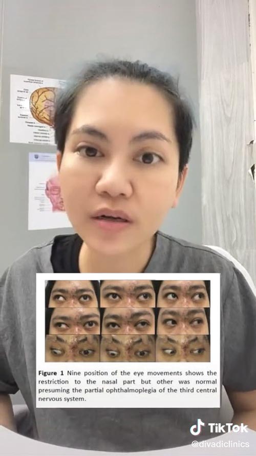 ฉีดฟิลเลอร์ตาบอด ฉีดฟิลเลอร์ตาบอด