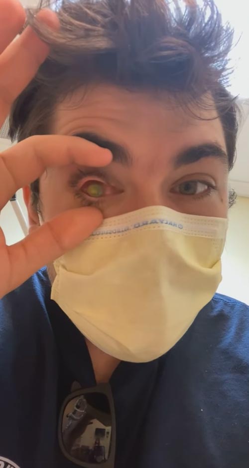 ใส่คอนแทคเลนส์นอน ตาอักเสบ ใส่คอนแทคเลนส์นอน ตาอักเสบ