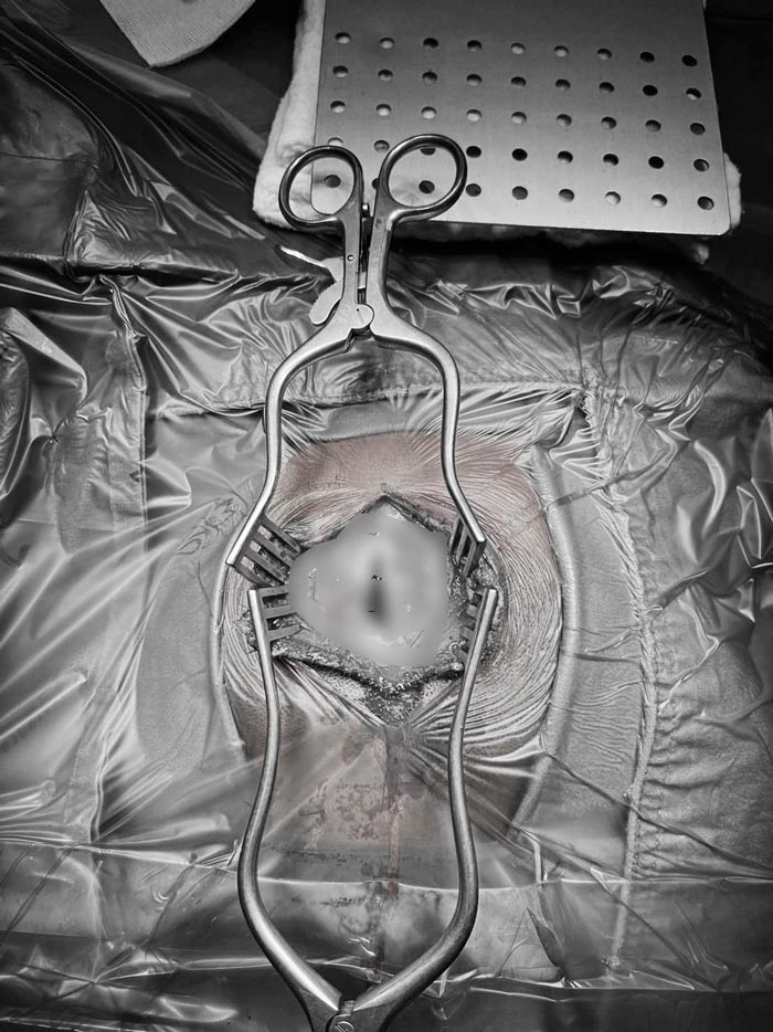 กะโหลกศีรษะแตก ฝังในสมอง กะโหลกศีรษะแตก ฝังในสมอง